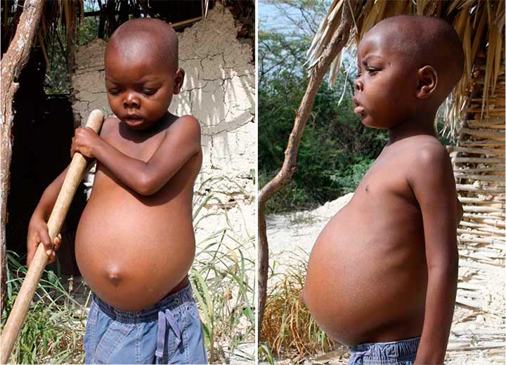 effects-of-malnutrition-in-haiti-love-a-child