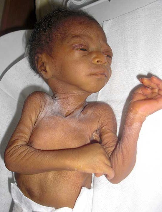 Effects of Malnutrition in Haiti - Love A Child