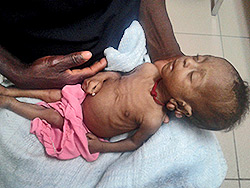 A young patient at our Malnutrition Center in Haiti