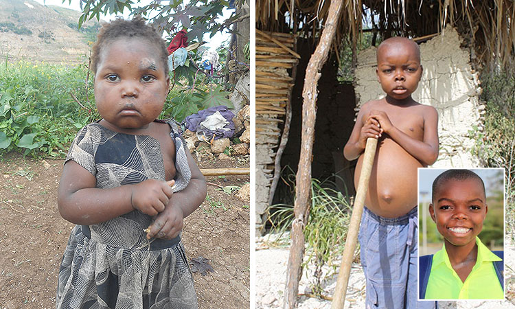 Dangers of Kwashiorkor: 1-21-19 12:00 PM